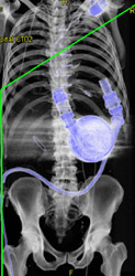 Left Ventricular Assist Device - CTisus CT Scan