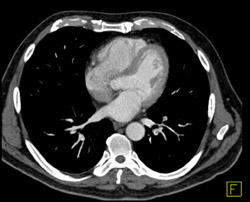 Pulmonary Embolism - CTisus CT Scan