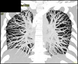 Pulmonary Vasculature - CTisus CT Scan