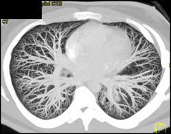 MIP of Pulmonary Vessels - CTisus CT Scan