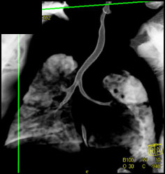 Narrowing of Left Mainstem Bronchus - CTisus CT Scan