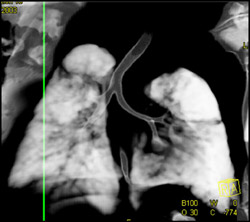 Narrowed Left Mainstem Bronchus - CTisus CT Scan