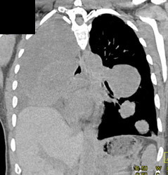 Metastatic Sarcoma - CTisus CT Scan