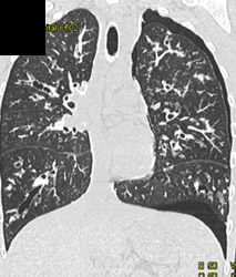 Bronchiectasis - CTisus CT Scan