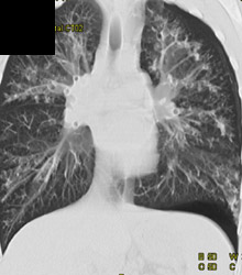 Bronchiectasis - CTisus CT Scan