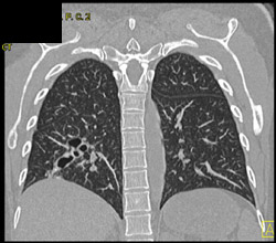 Bronchiectasis in Right Lower Lobe - CTisus CT Scan