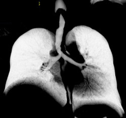 Encasement of Trachea - CTisus CT Scan