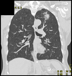 Left Upper Lung Cancer - CTisus CT Scan