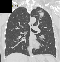 Left Upper Lobe Carcinoma - CTisus CT Scan