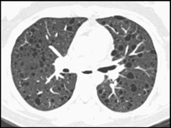 Lymphangioleiomyomatosis (LAM) - CTisus CT Scan