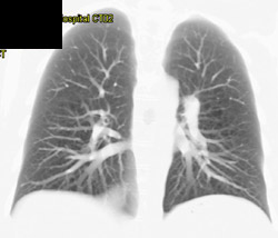 Lymphangioleiomyomatosis (LAM) - CTisus CT Scan