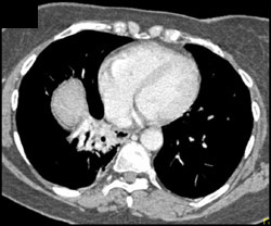 Bronchiectasis - CTisus CT Scan