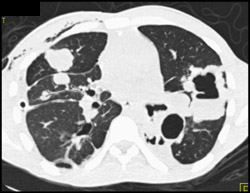 Tracheal Papillomatosis - CTisus CT Scan