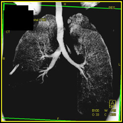 Bronchiectasis in Right Lower Lobe - CTisus CT Scan