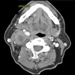 Enlarged Node in Right Neck (lymphoma) - CTisus CT Scan