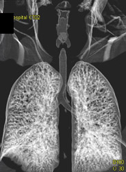 Normal Airways - CTisus CT Scan