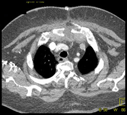 Dehiesence of Sternum - CTisus CT Scan