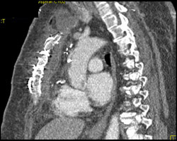 Chest Wall Infection Post Coronary Artery Bypass Graft (CABG) - CTisus CT Scan