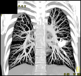 Prior Embolization of Left Pulmonary Arteriovenous Malformation (PAVM) - CTisus CT Scan