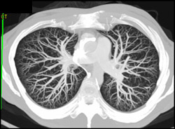 Tiny Left Pulmonary Arteriovenous Malformation (PAVM) - CTisus CT Scan