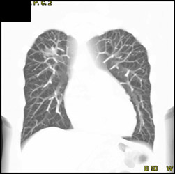 Bronchoalveolar Carcinoma (BAC) - CTisus CT Scan