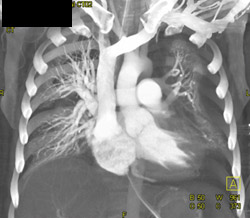 3D With Prominent Pulmonary Artery - CTisus CT Scan