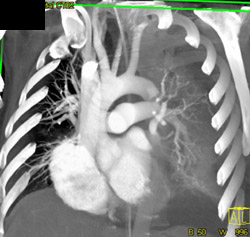 Normal Arch - CTisus CT Scan