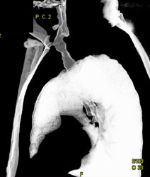 Tracheal Stenosis - CTisus CT Scan