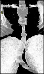 Tracheal Stenosis - CTisus CT Scan