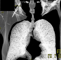 Tracheal Stenosis - CTisus CT Scan