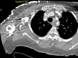 Occluded Brachiocephalic Vein - CTisus CT Scan