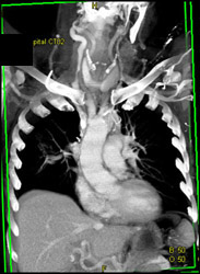 Carotid Artery - CTisus CT Scan