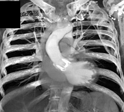 Aortic Valve Replacement - CTisus CT Scan