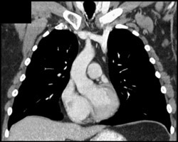 Persistent Left Superior Vena Cava (SVC) - CTisus CT Scan