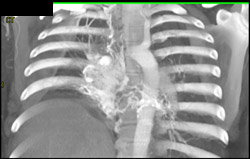 Collaterals in Right Hilum and Mediastinum - CTisus CT Scan