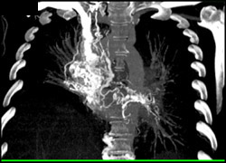 Collaterals in Mediastinum - CTisus CT Scan