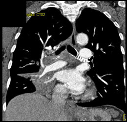 Mediastinal Adenopathy - CTisus CT Scan