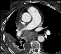 Encased Right Pulmonary Artery By Tumor - CTisus CT Scan