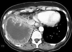 Implants on Pleura- Adenocarcinoma - CTisus CT Scan