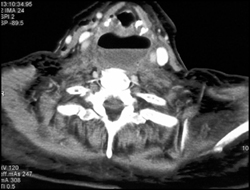 Obstructed Esophagus Due to Double Arch With Perforation - CTisus CT Scan