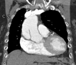 Type A Dissection - CTisus CT Scan