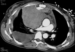 Mediastinal Hematoma With Active Leak - CTisus CT Scan