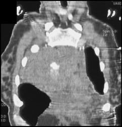 Active Leak Post Trauma - CTisus CT Scan