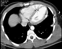 Bullet in Intraventricular Septum - CTisus CT Scan