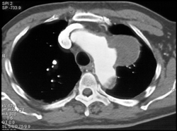 Pseudoaneurysm - CTisus CT Scan