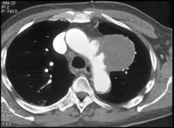 Aortic Pseudoaneurysm With Ulcer - CTisus CT Scan