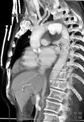 Ductus Aneurysm - CTisus CT Scan