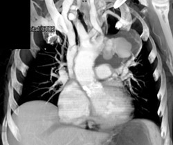 Ductus Aneurysm - CTisus CT Scan