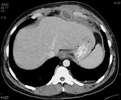 Anterior Mediastinal Abscess - CTisus CT Scan