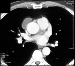 Pericardial Cyst - CTisus CT Scan